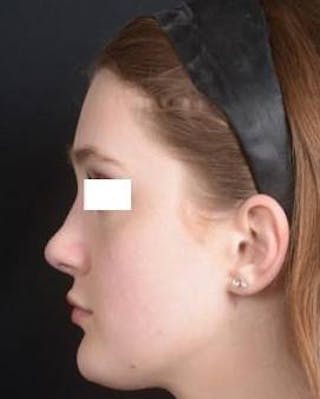 Rhinoplasty Before & After Gallery - Patient 183452 - Image 4