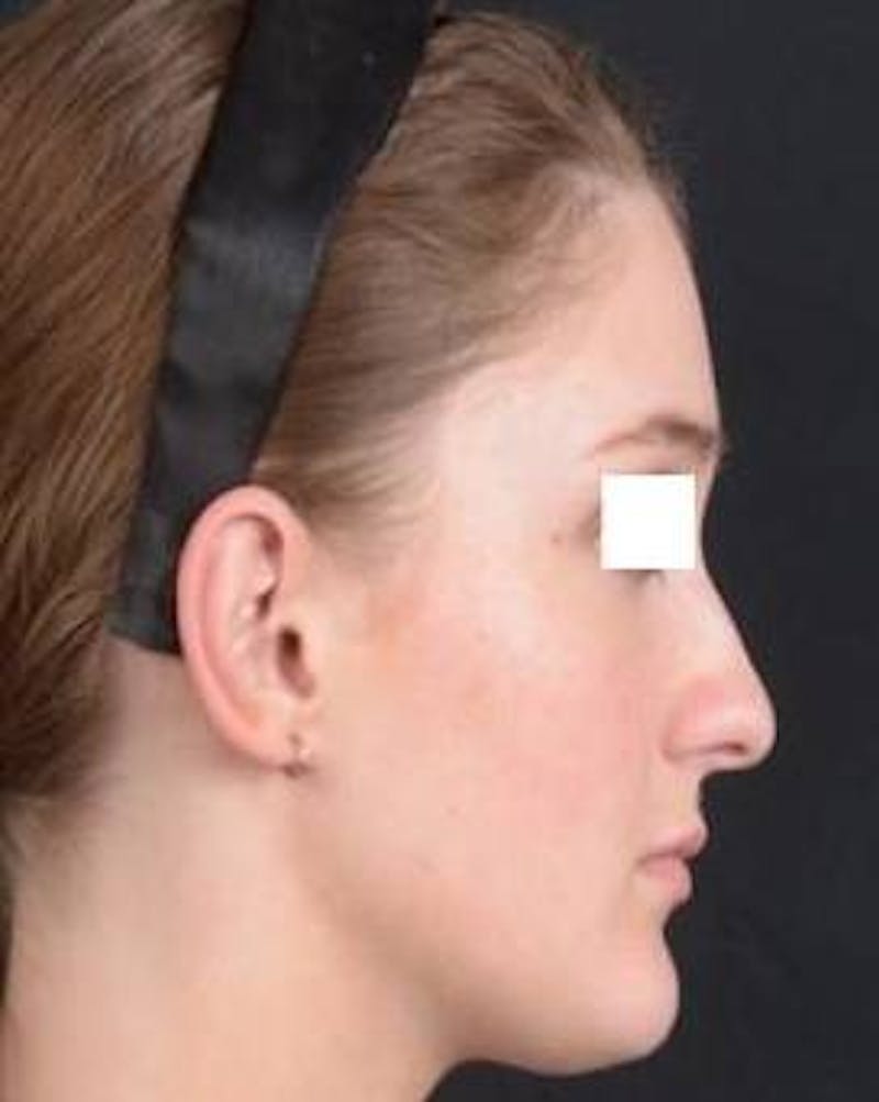 Rhinoplasty Before & After Gallery - Patient 183452 - Image 5