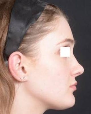 Rhinoplasty Before & After Gallery - Patient 183452 - Image 6