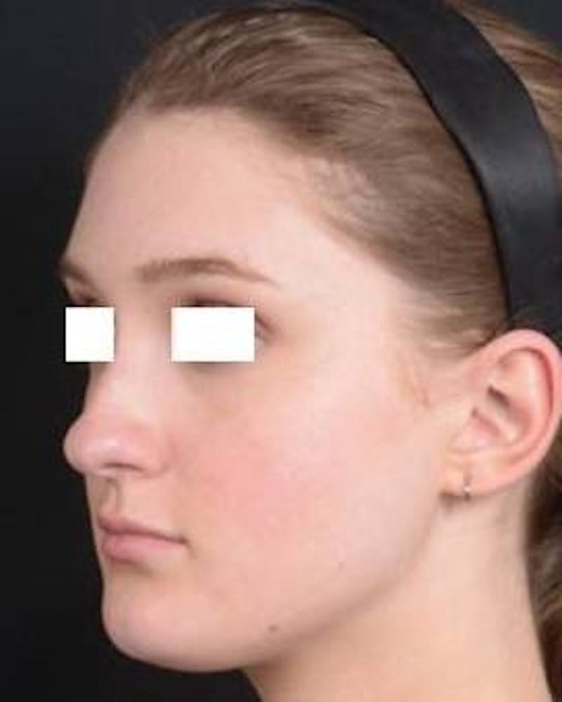 Rhinoplasty Before & After Gallery - Patient 183452 - Image 7
