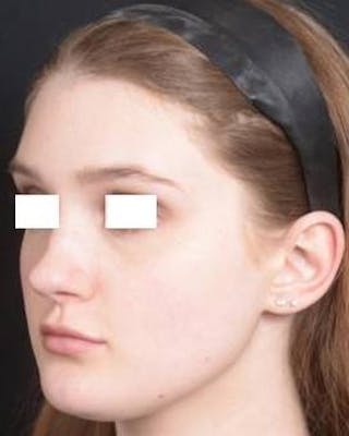 Rhinoplasty Before & After Gallery - Patient 183452 - Image 8