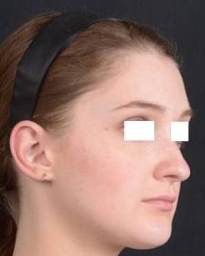 Rhinoplasty Before & After Gallery - Patient 183452 - Image 9