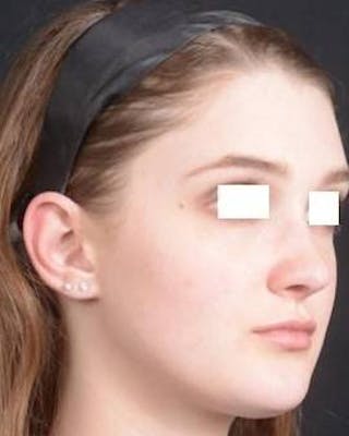 Rhinoplasty Before & After Gallery - Patient 183452 - Image 10