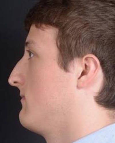Rhinoplasty Before & After Gallery - Patient 311849 - Image 1