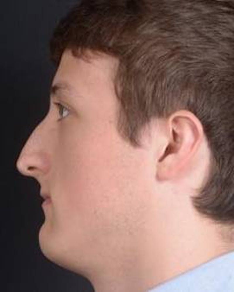 Rhinoplasty Before & After Gallery - Patient 311849 - Image 1