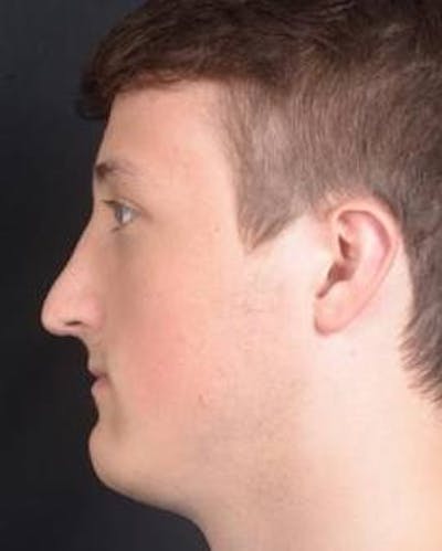 Rhinoplasty Before & After Gallery - Patient 311849 - Image 2