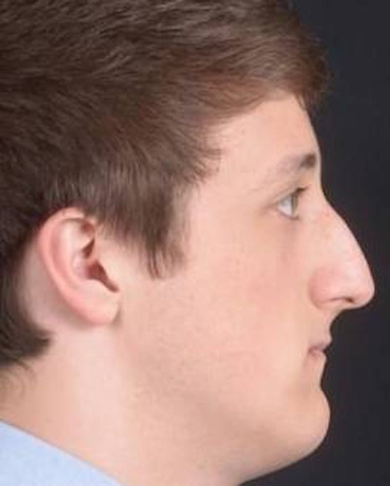 Rhinoplasty Before & After Gallery - Patient 311849 - Image 3
