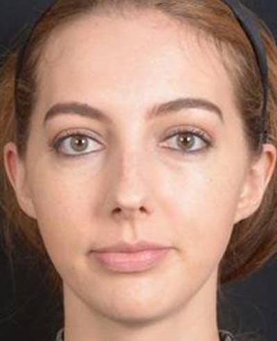 Rhinoplasty Before & After Gallery - Patient 385171 - Image 1