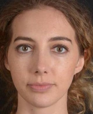 Rhinoplasty Before & After Gallery - Patient 385171 - Image 2