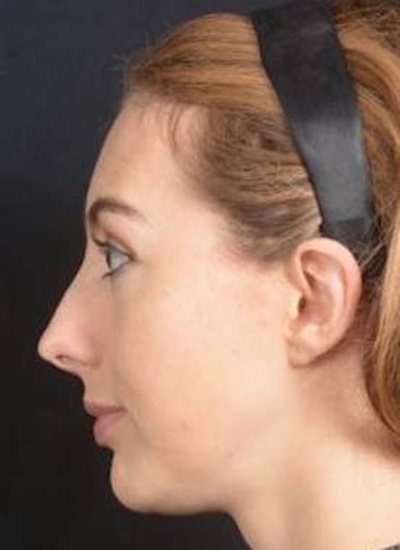 Rhinoplasty Before & After Gallery - Patient 385171 - Image 3