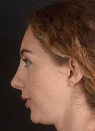 Rhinoplasty Before & After Gallery - Patient 385171 - Image 4