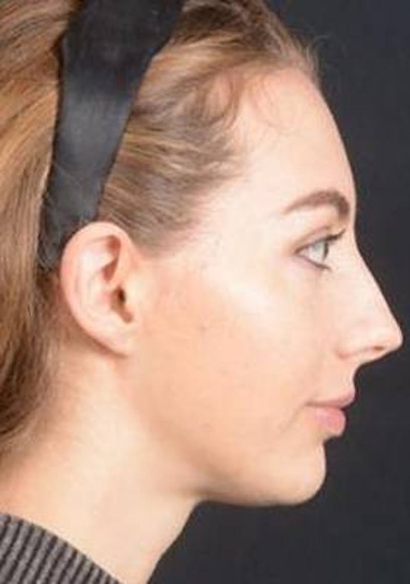 Rhinoplasty Before & After Gallery - Patient 385171 - Image 5