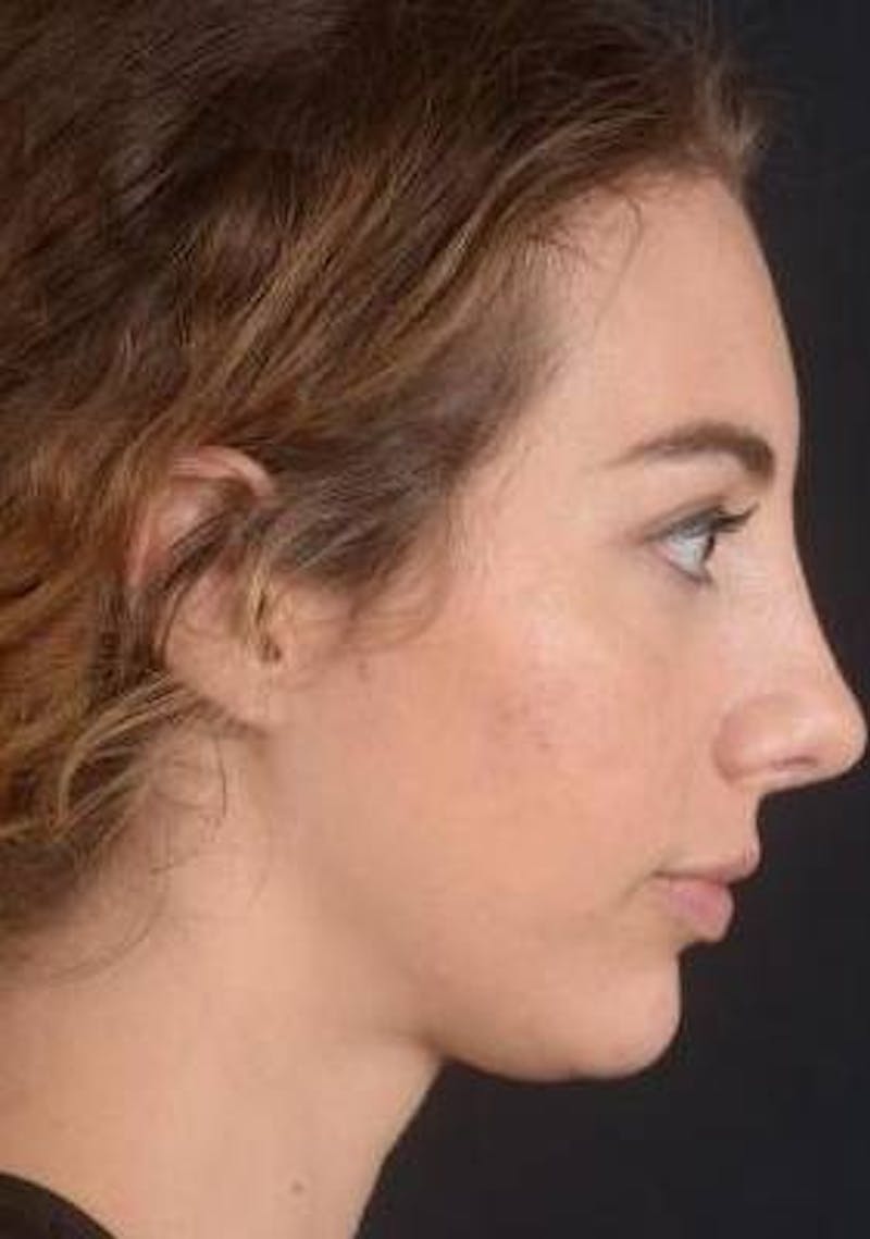 Rhinoplasty Before & After Gallery - Patient 385171 - Image 6