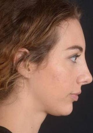 Rhinoplasty Before & After Gallery - Patient 385171 - Image 6