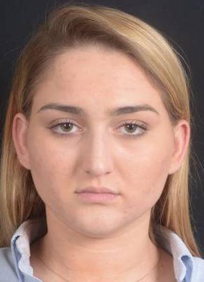 Rhinoplasty Before & After Gallery - Patient 187205 - Image 1