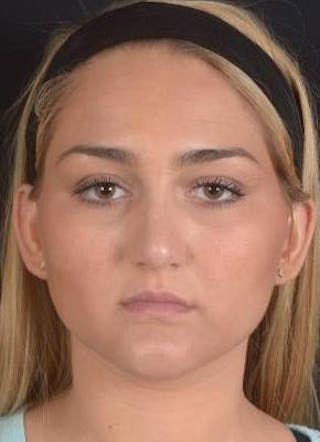 Rhinoplasty Before & After Gallery - Patient 187205 - Image 2