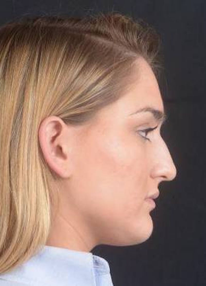 Rhinoplasty Before & After Gallery - Patient 187205 - Image 5
