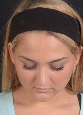 Rhinoplasty Before & After Gallery - Patient 187205 - Image 8