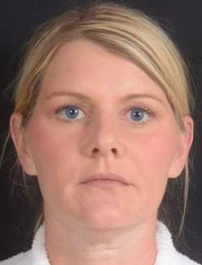 Rhinoplasty Before & After Gallery - Patient 344569 - Image 1