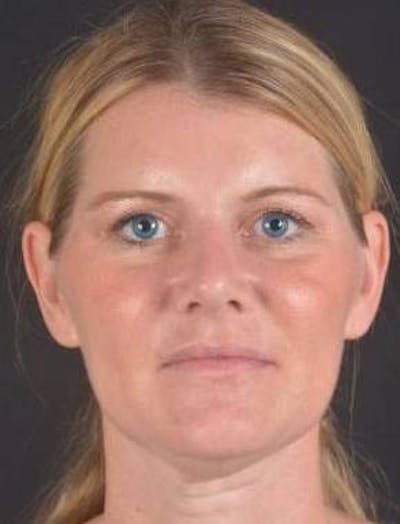 Rhinoplasty Before & After Gallery - Patient 344569 - Image 2