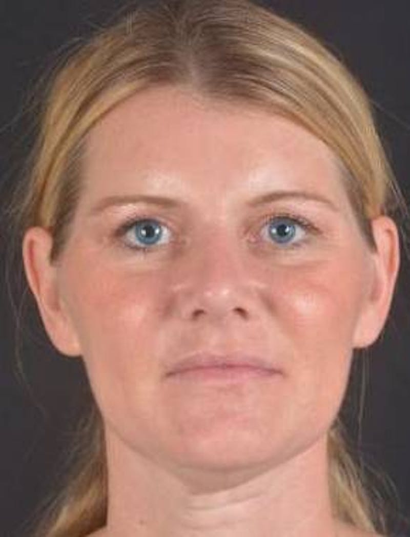 Rhinoplasty Before & After Gallery - Patient 344569 - Image 2