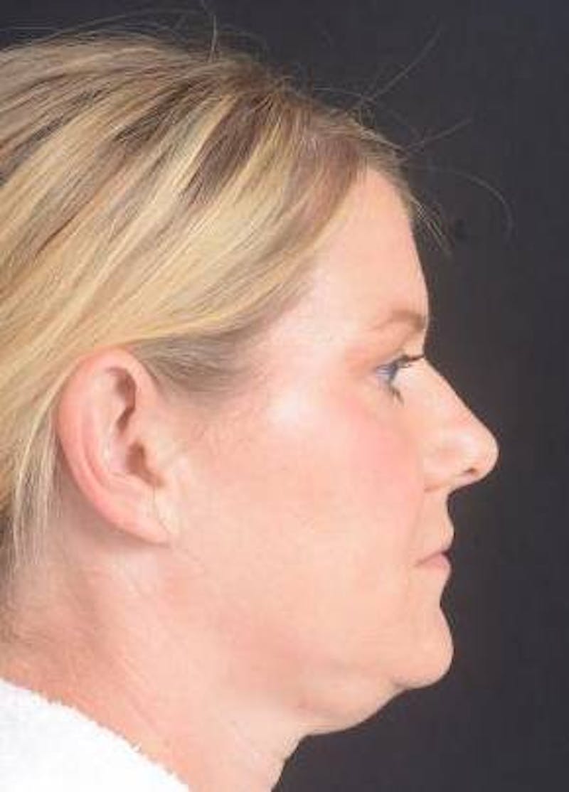 Rhinoplasty Before & After Gallery - Patient 344569 - Image 3