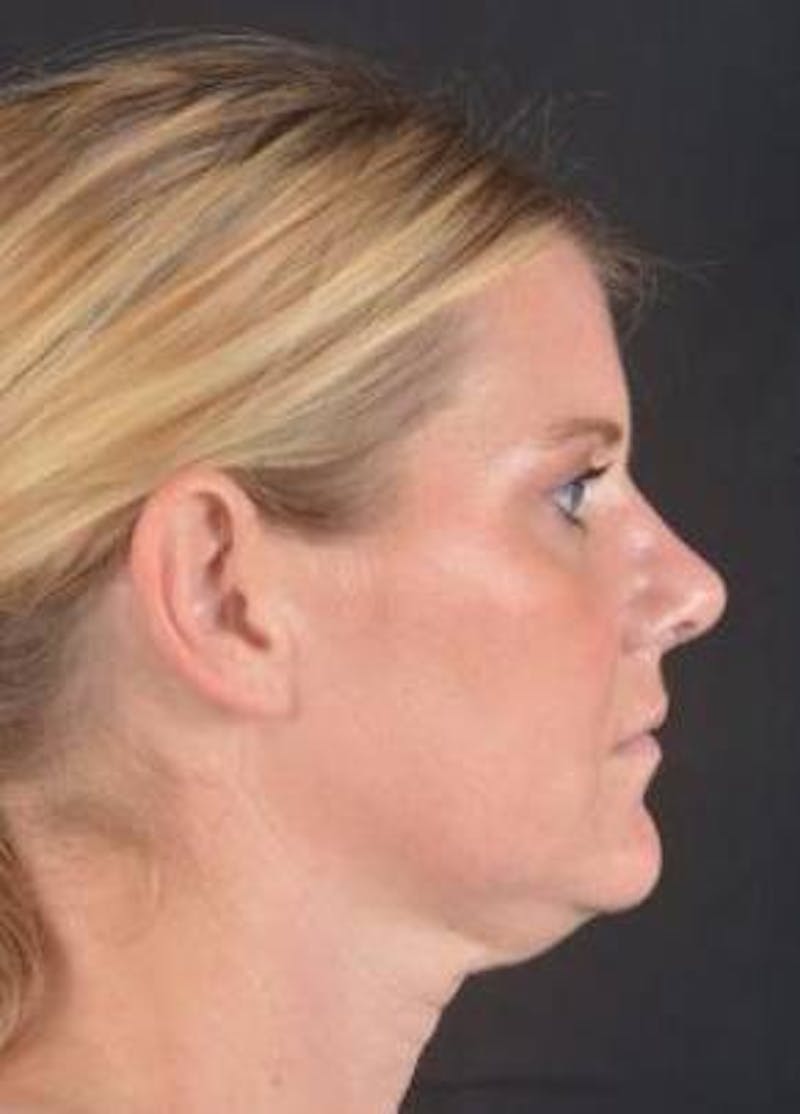 Rhinoplasty Before & After Gallery - Patient 344569 - Image 4