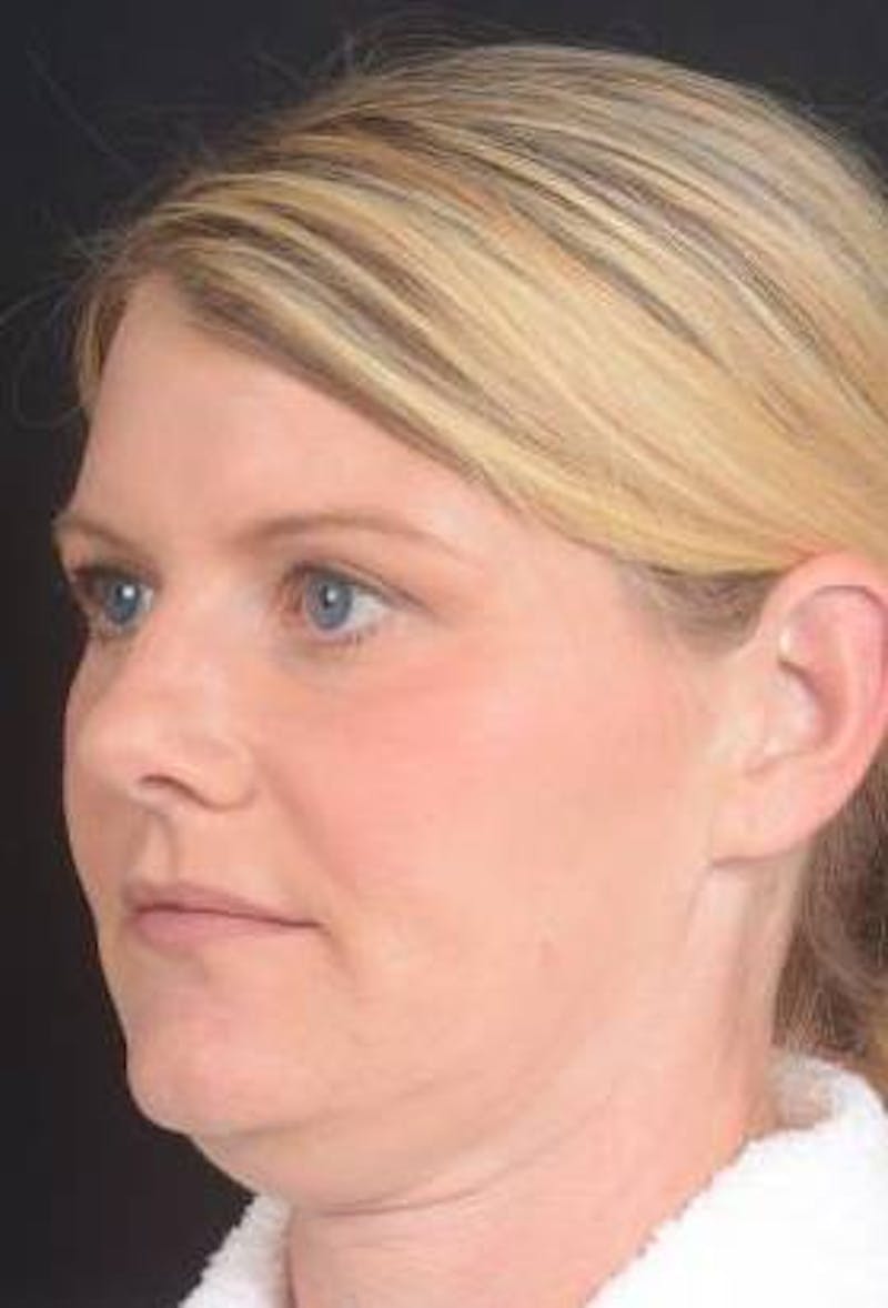 Rhinoplasty Before & After Gallery - Patient 344569 - Image 5