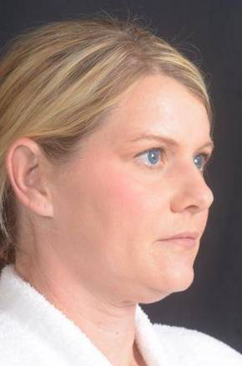 Rhinoplasty Before & After Gallery - Patient 344569 - Image 7