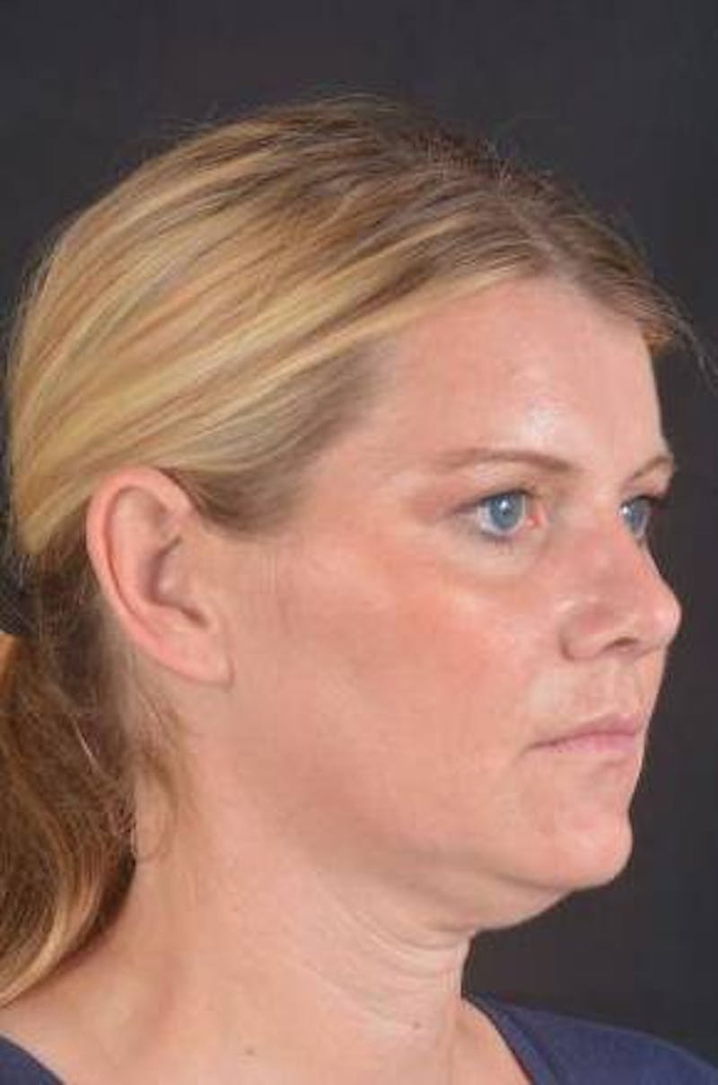 Rhinoplasty Before & After Gallery - Patient 344569 - Image 8