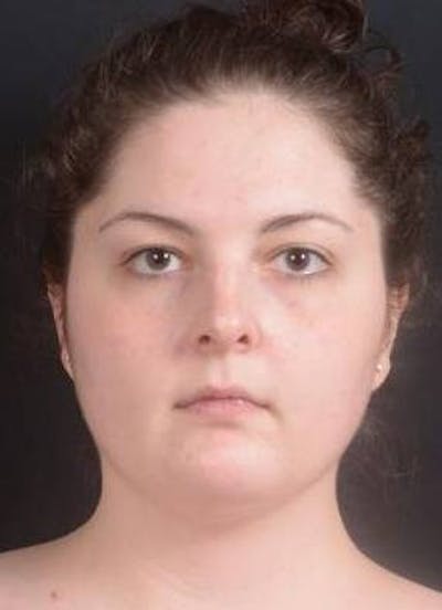 Rhinoplasty Before & After Gallery - Patient 352125 - Image 1