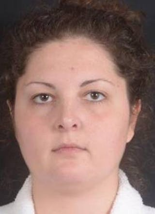 Rhinoplasty Before & After Gallery - Patient 352125 - Image 2