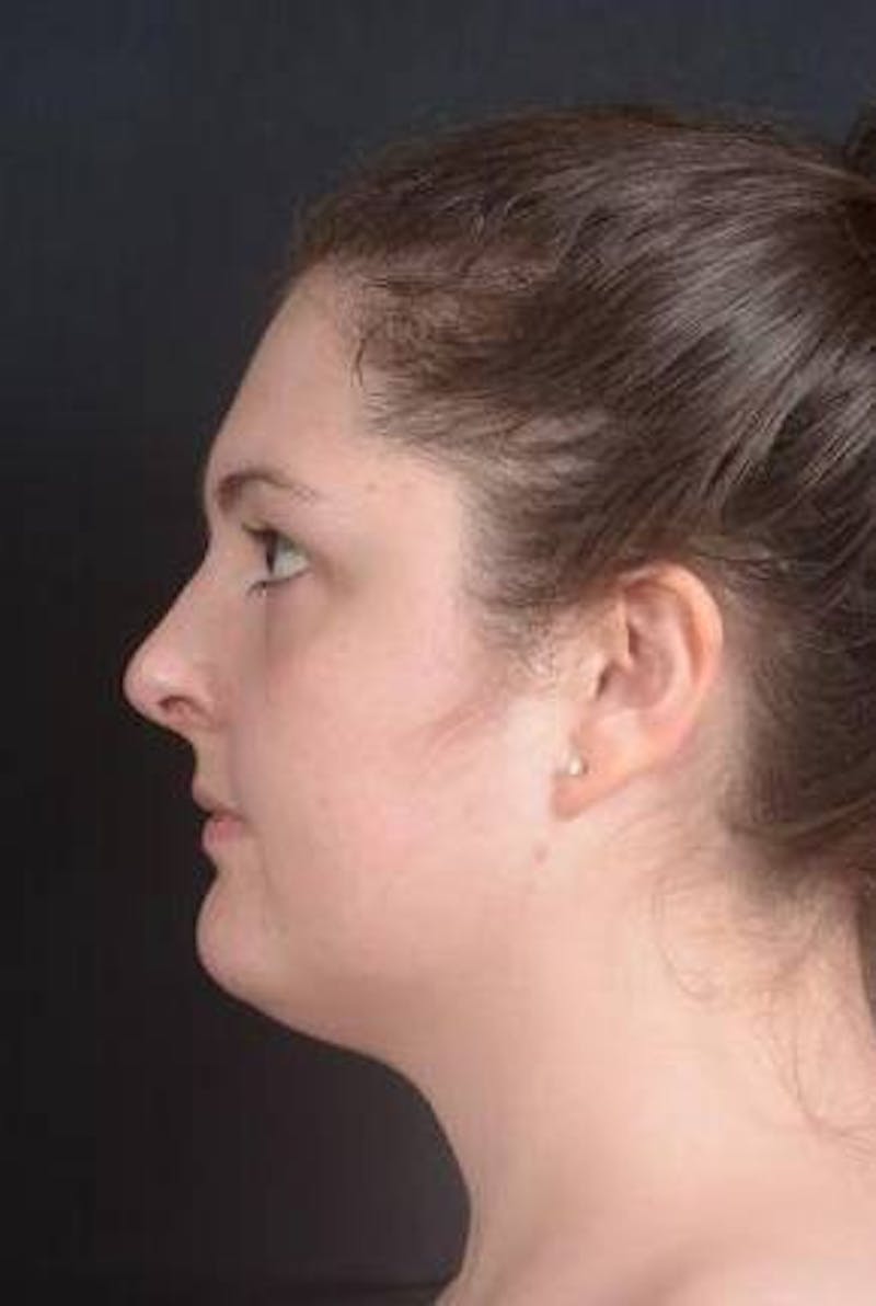 Rhinoplasty Before & After Gallery - Patient 352125 - Image 3