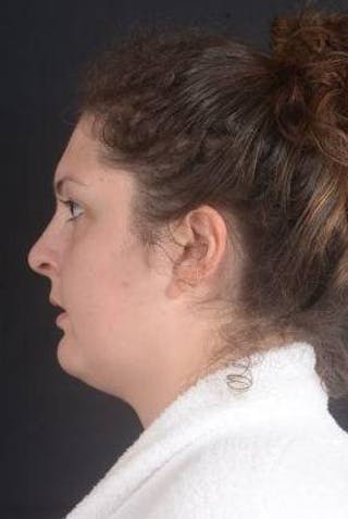 Rhinoplasty Before & After Gallery - Patient 352125 - Image 4