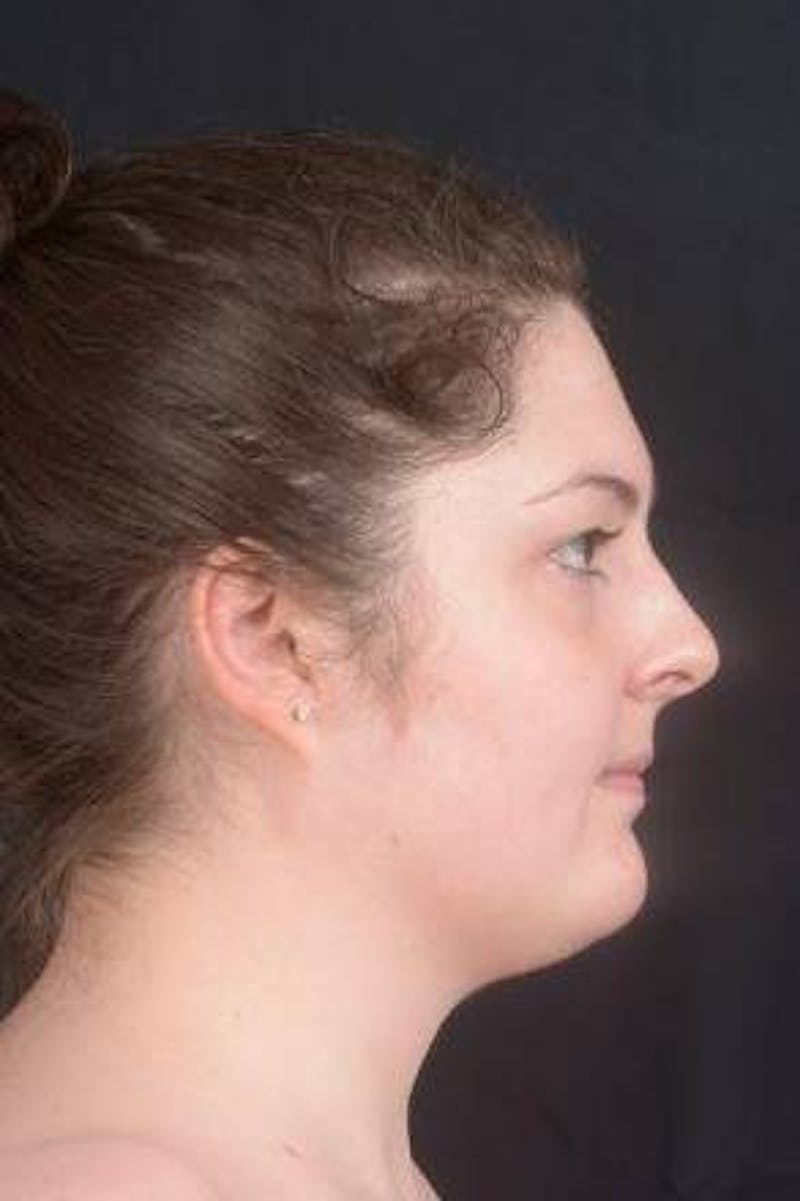 Rhinoplasty Before & After Gallery - Patient 352125 - Image 5