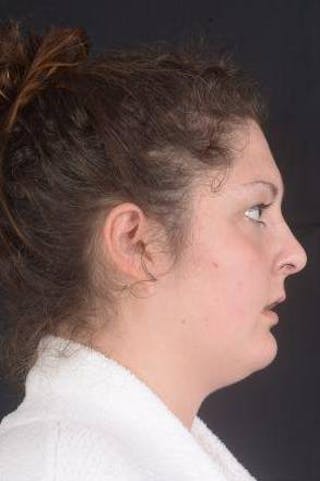 Rhinoplasty Before & After Gallery - Patient 352125 - Image 6