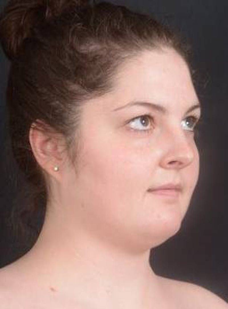 Rhinoplasty Before & After Gallery - Patient 352125 - Image 7