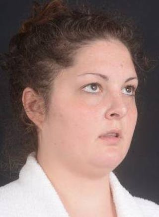 Rhinoplasty Before & After Gallery - Patient 352125 - Image 8