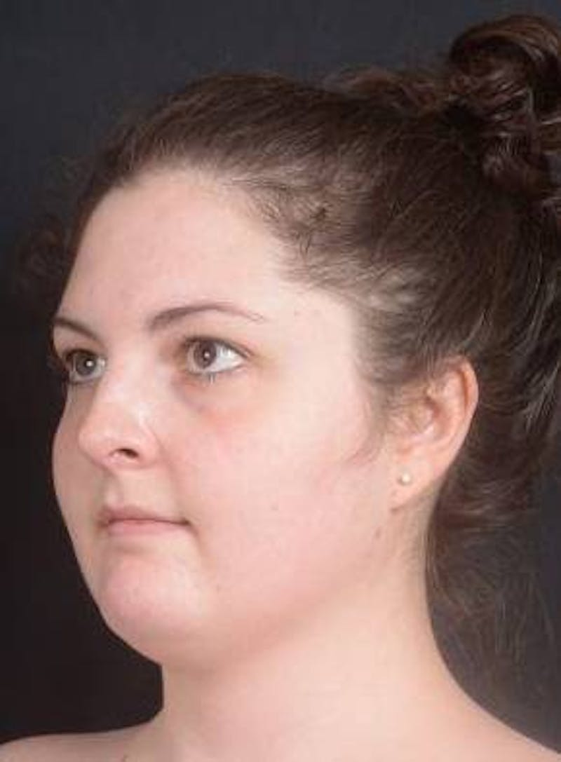 Rhinoplasty Before & After Gallery - Patient 352125 - Image 9