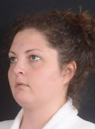 Rhinoplasty Before & After Gallery - Patient 352125 - Image 10