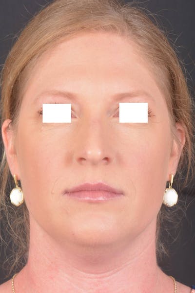 Rhinoplasty Before & After Gallery - Patient 355346 - Image 1