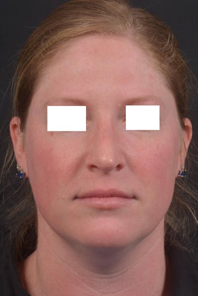 Rhinoplasty Before & After Gallery - Patient 355346 - Image 2