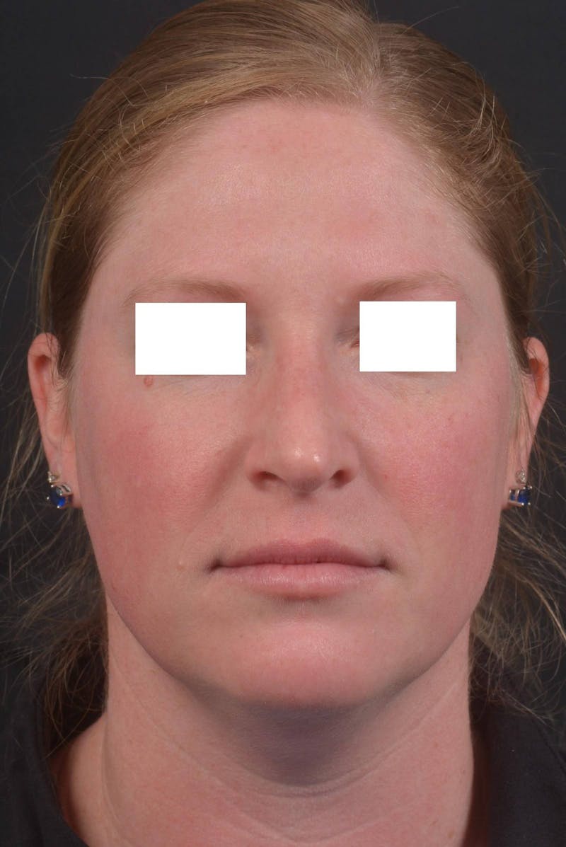 Rhinoplasty Before & After Gallery - Patient 355346 - Image 2