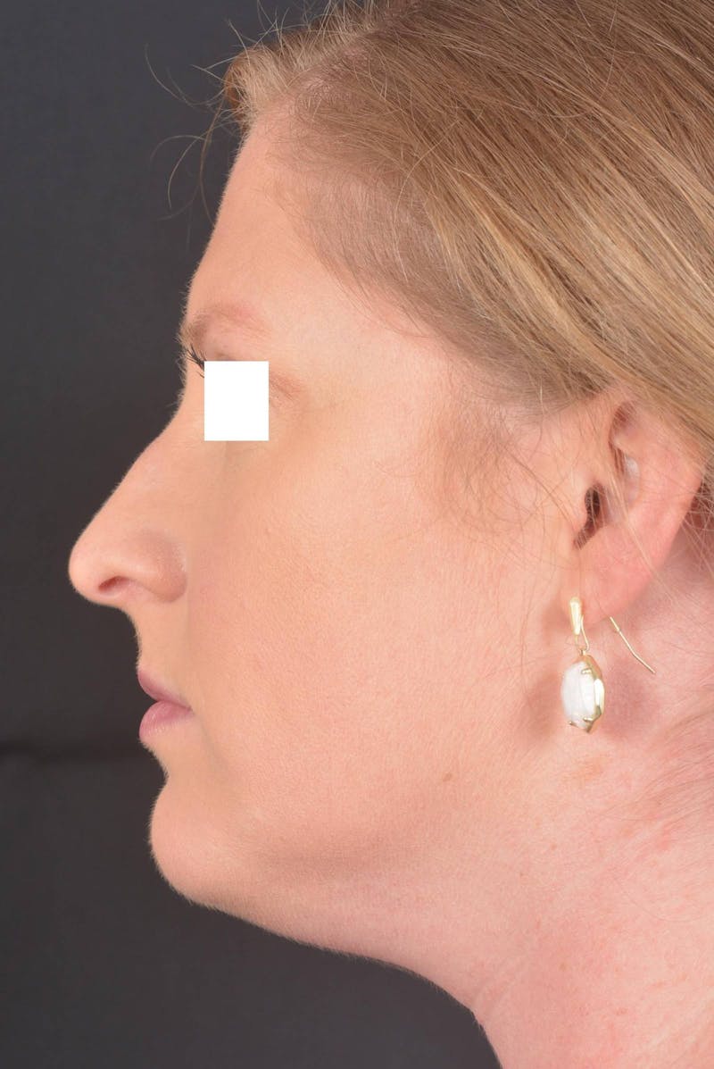 Rhinoplasty Before & After Gallery - Patient 355346 - Image 3