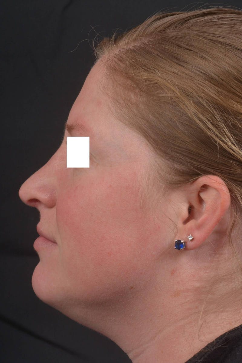 Rhinoplasty Before & After Gallery - Patient 355346 - Image 4