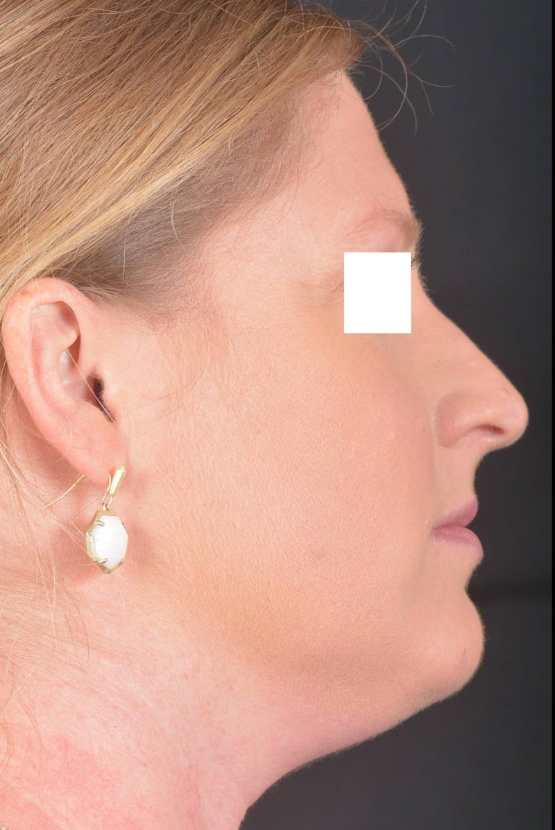 Rhinoplasty Before & After Gallery - Patient 355346 - Image 5