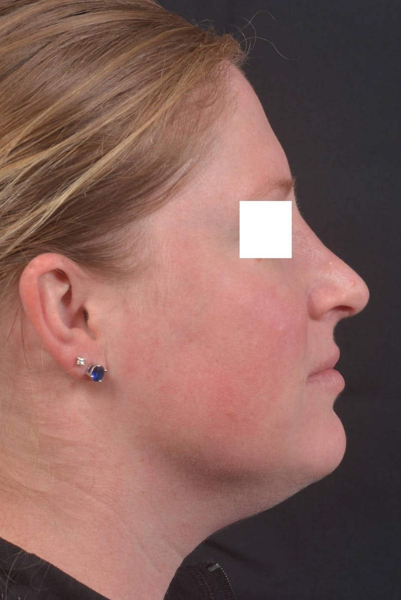 Rhinoplasty Before & After Gallery - Patient 355346 - Image 6