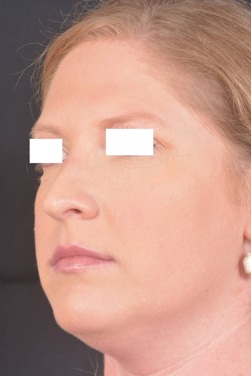 Rhinoplasty Before & After Gallery - Patient 355346 - Image 7