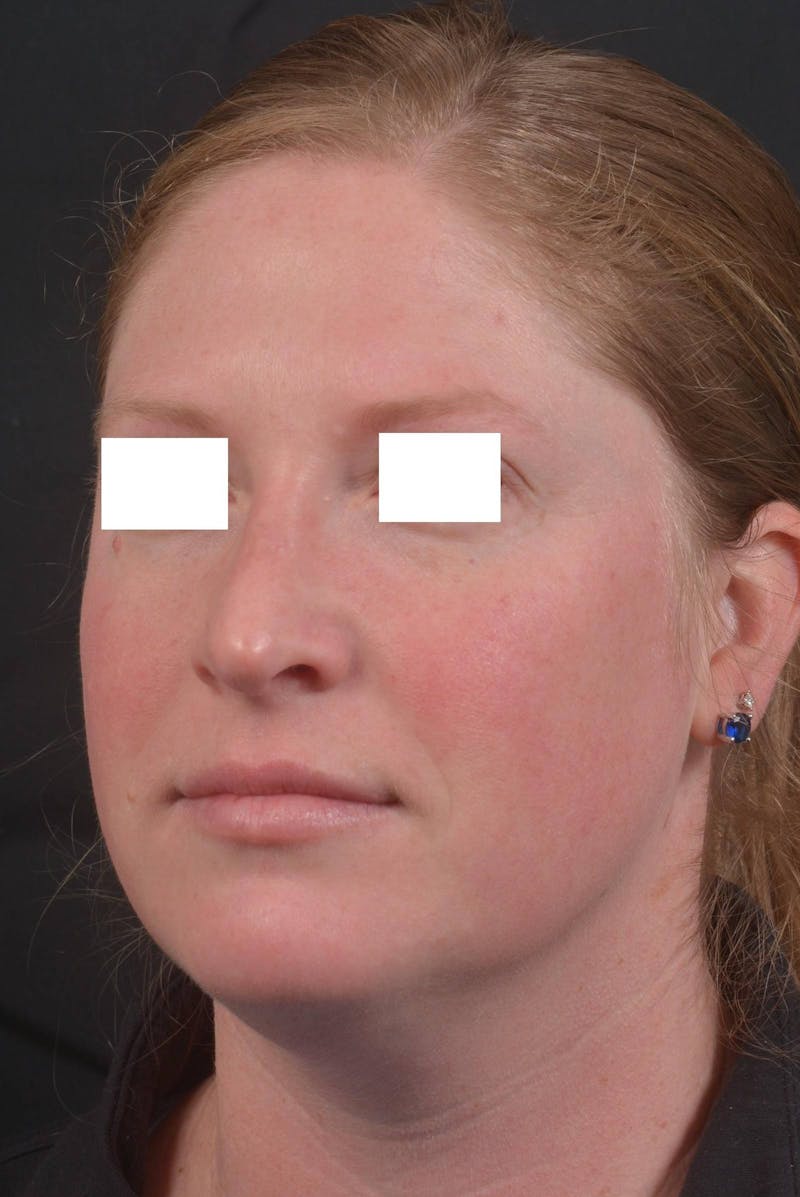Rhinoplasty Before & After Gallery - Patient 355346 - Image 8