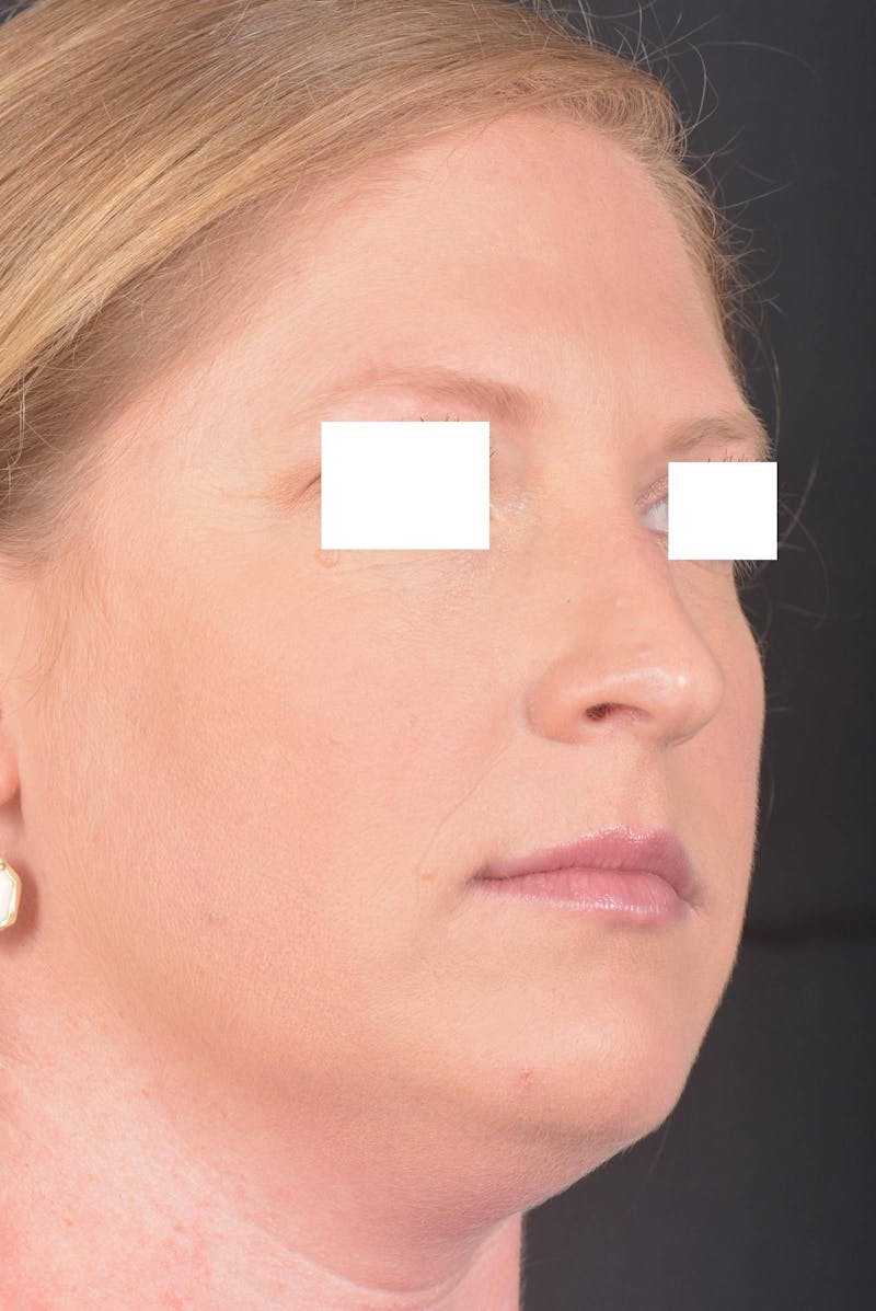 Rhinoplasty Before & After Gallery - Patient 355346 - Image 9